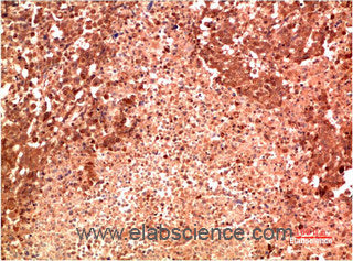 Immunohistochemistry of paraffin-embedded Human lung carcinoma  tissue using P38 Monoclonal Antibody at dilution of 1:200.