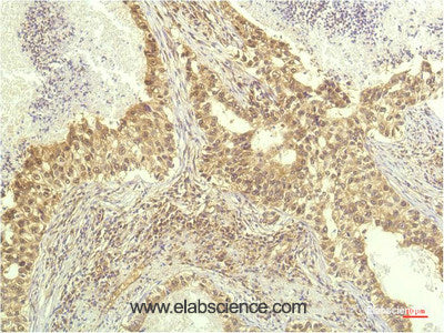 Immunohistochemistry of paraffin-embedded Human lung carcinoma tissue using p70 S6 kinase alpha Monoclonal Antibody at dilution of 1:200.