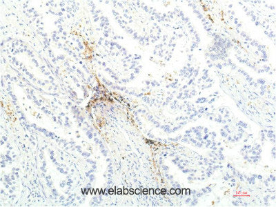 Immunohistochemistry of paraffin-embedded Human lung carcinoma tissue using JAK1 Monoclonal Antibody at dilution of 1:200.