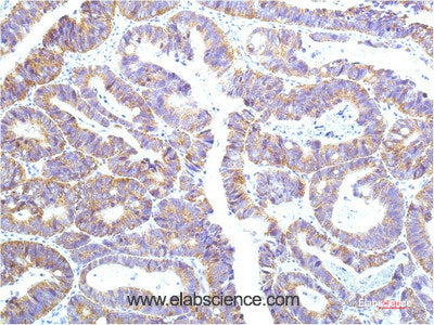 Immunohistochemistry of paraffin-embedded Human colon carcinoma tissue using STAT1 Monoclonal Antibody at dilution of 1:200.