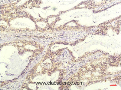 Immunohistochemistry of paraffin-embedded Human lung carcinoma tissue using IL8 Monoclonal Antibody at dilution of 1:200.