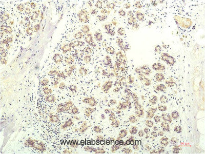 Immunohistochemistry of paraffin-embedded Human breast carcinoma tissue using STAT1 Monoclonal Antibody at dilution of 1:200.