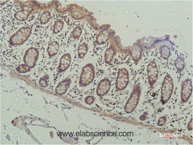 Immunohistochemistry of paraffin-embedded Human colon carcinoma tissue using HDAC1 Monoclonal Antibody at dilution of 1:200.