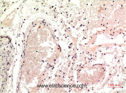 Immunohistochemistry of paraffin-embedded Human colon carcinoma tissue using gamma Tubulin Monoclonal Antibody at dilution of 1:200.