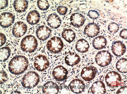 Immunohistochemistry of paraffin-embedded Human colon carcinoma tissue using PTEN Monoclonal Antibody at dilution of 1:200.