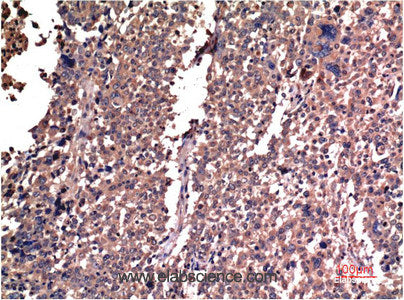 Immunohistochemistry of paraffin-embedded Human lung carcinoma tissue using Cyclin B1 Monoclonal Antibody at dilution of 1:200.