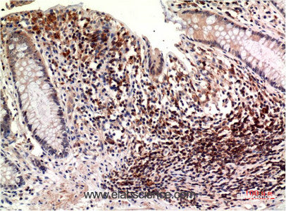 Immunohistochemistry of paraffin-embedded Human colon carcinoma tissue using Epsilon Tubulin Monoclonal Antibody at dilution of 1:200.