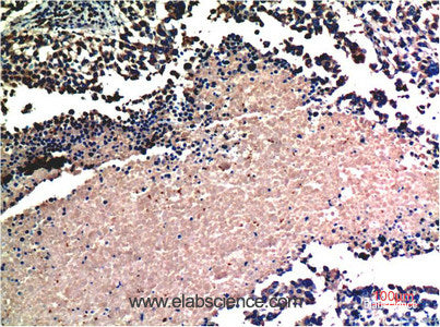 Immunohistochemistry of paraffin-embedded Human lung carcinoma tissue using AKT1 Monoclonal Antibody at dilution of 1:200.