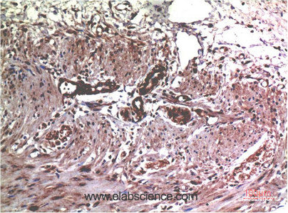 Immunohistochemistry of paraffin-embedded Human colon carcinoma tissue using MMP2 Monoclonal Antibody at dilution of 1:200.