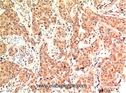 Immunohistochemistry of paraffin-embedded Human breast carcinoma tissue using ERK 1 Monoclonal Antibody at dilution of 1:200.