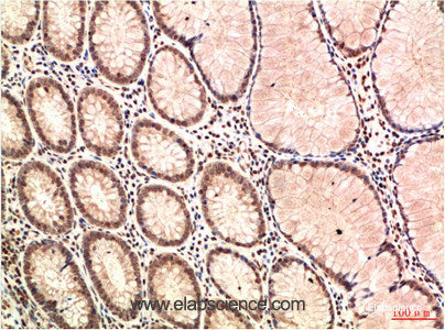 Immunohistochemistry of paraffin-embedded Human colon carcinoma tissue using ATM Monoclonal Antibody at dilution of 1:200.