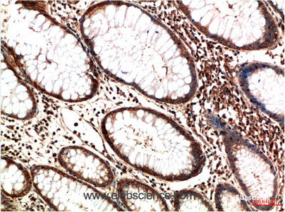 Immunohistochemistry of paraffin-embedded Human colon carcinoma tissue using ATM Monoclonal Antibody at dilution of 1:200.