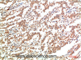 Immunohistochemistry of paraffin-embedded Human lung carcinoma tissue using JAK2 Monoclonal Antibody at dilution of 1:200.