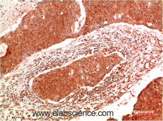 Immunohistochemistry of paraffin-embedded Human breast carcinoma tissue using JAK2 Monoclonal Antibody at dilution of 1:200.