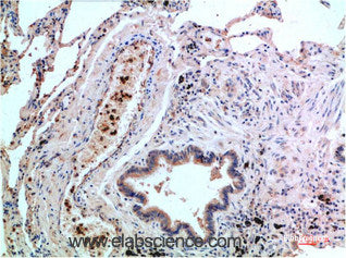 Immunohistochemistry of paraffin-embedded Human lung carcinoma tissue using P38 Monoclonal Antibody at dilution of 1:200.