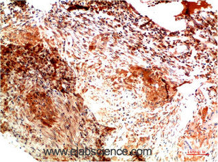 Immunohistochemistry of paraffin-embedded Human lung carcinoma tissue using COL2A1 Monoclonal Antibody at dilution of 1:200.