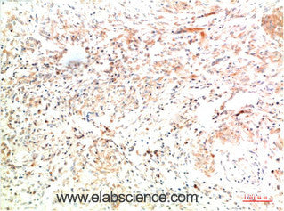 Immunohistochemistry of paraffin-embedded Human lung carcinoma tissue using COL2A1 Monoclonal Antibody at dilution of 1:200.