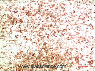 Immunohistochemistry of paraffin-embedded Human ovarian carcinoma tissue using ATG5 Monoclonal Antibody at dilution of 1:200.