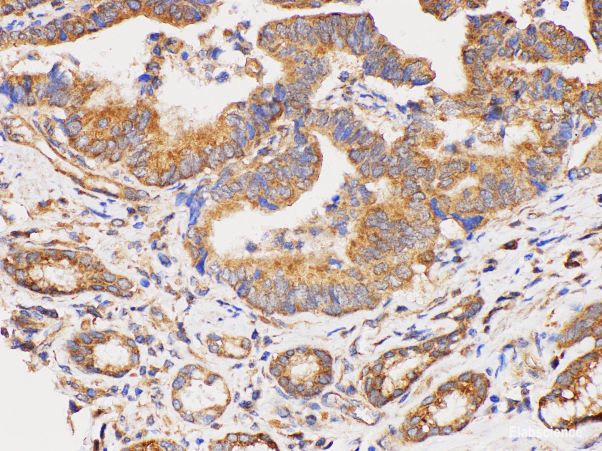 Immunohistochemistry of paraffin-embedded Human duodenal cancer using DMBT1 Polycloanl Antibody at dilution of 1:300