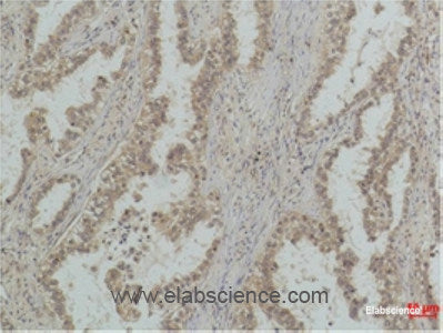 Immunohistochemistry of paraffin-embedded Human lung carcinoma tissue using P53 (Mono Methyl Lys370) Monoclonal Antibody at dilution of 1:500.