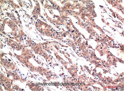 Immunohistochemistry of paraffin-embedded Human colon carcinoma tissue using Phospho-STAT3 (Tyr705) Monoclonal Antibody at dilution of 1:200.