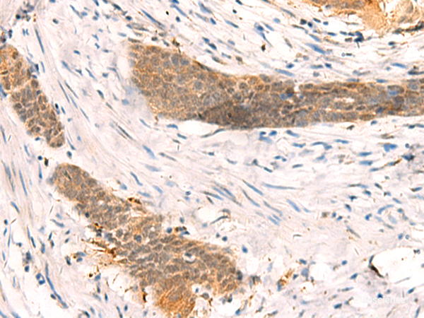Immunohistochemistry of paraffin-embedded Human esophagus cancer tissue  using SETD1A Polyclonal Antibody at dilution of 1:40(×200)