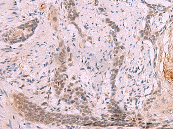 Immunohistochemistry of paraffin-embedded Human esophagus cancer tissue  using INO80 Polyclonal Antibody at dilution of 1:70(×200)