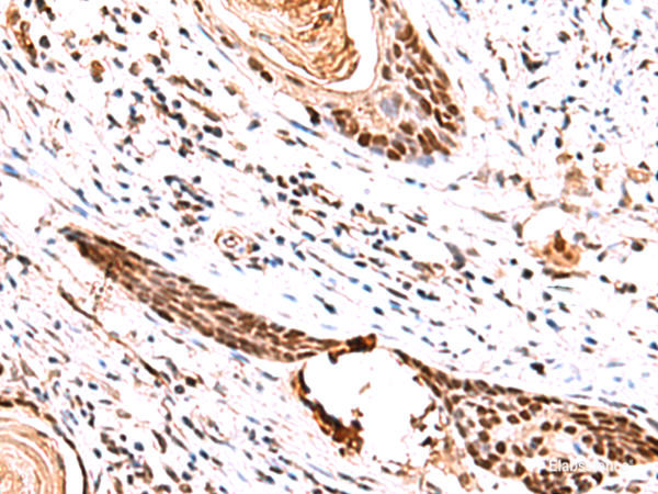 Immunohistochemistry of paraffin-embedded Human esophagus cancer tissue  using IRF2BP1 Polyclonal Antibody at dilution of 1:30(×200)
