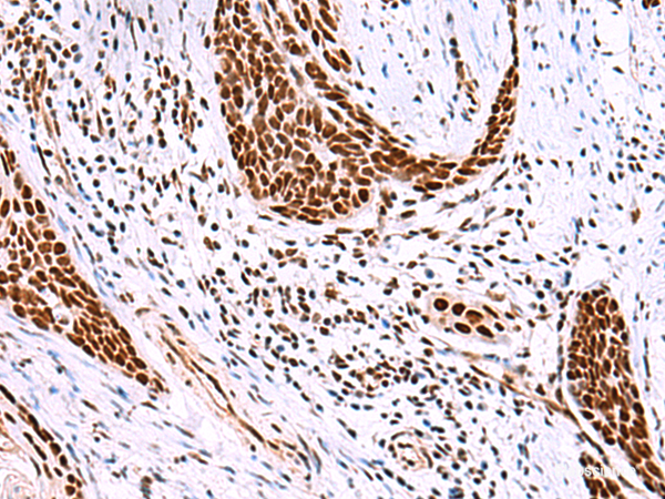 Immunohistochemistry of paraffin-embedded Human esophagus cancer tissue  using ISY1-RAB43 Polyclonal Antibody at dilution of 1:30(×200)