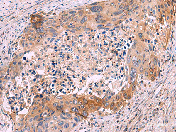 Immunohistochemistry of paraffin-embedded Human cervical cancer tissue  using GRIK4 Polyclonal Antibody at dilution of 1:50(×200)