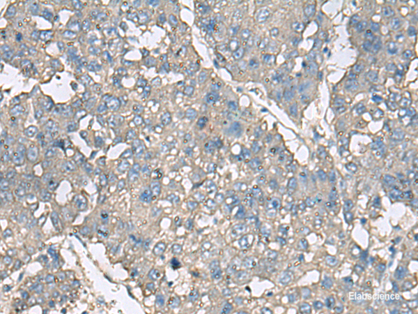 Immunohistochemistry of paraffin-embedded Human liver cancer tissue  using TNF Polyclonal Antibody at dilution of 1:40(×200)