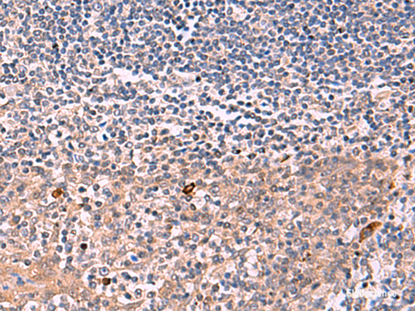 Immunohistochemistry of paraffin-embedded Human tonsil tissue  using IFNA1:IFNA13 Polyclonal Antibody at dilution of 1:35(×200)