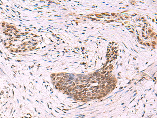 Immunohistochemistry of paraffin-embedded Human esophagus cancer tissue  using CREBBP Polyclonal Antibody at dilution of 1:35(×200)