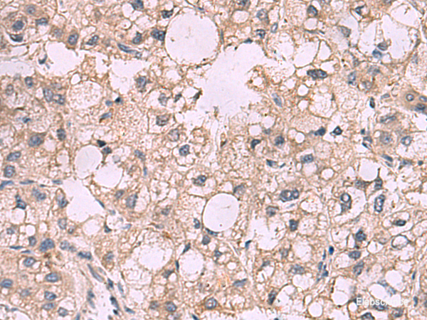 Immunohistochemistry of paraffin-embedded Human liver cancer tissue  using KCNIP1 Polyclonal Antibody at dilution of 1:40(×200)