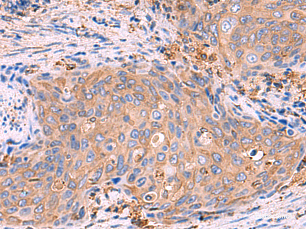 Immunohistochemistry of paraffin-embedded Human cervical cancer tissue  using G6PC Polyclonal Antibody at dilution of 1:70(×200)