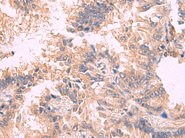 Immunohistochemistry of paraffin-embedded Human lung cancer tissue  using TJP1 Polyclonal Antibody at dilution of 1:30(×200)
