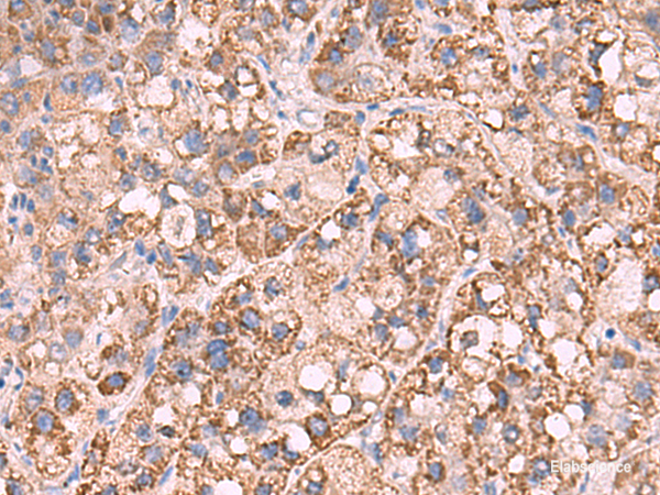 Immunohistochemistry of paraffin-embedded Human liver cancer tissue  using KCNN1 Polyclonal Antibody at dilution of 1:55(×200)