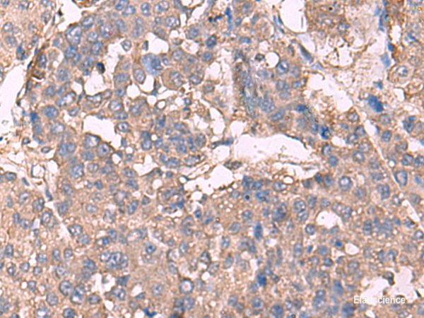 Immunohistochemistry of paraffin-embedded Human liver cancer tissue  using KCNN2 Polyclonal Antibody at dilution of 1:30(×200)