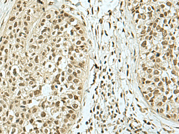 Immunohistochemistry of paraffin-embedded Human esophagus cancer tissue  using KHSRP Polyclonal Antibody at dilution of 1:40(×200)