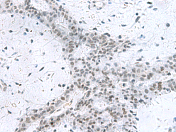 Immunohistochemistry of paraffin-embedded Human breast cancer tissue  using PCLAF Polyclonal Antibody at dilution of 1:80(×200)