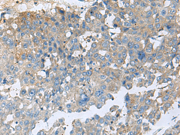 Immunohistochemistry of paraffin-embedded Human liver cancer tissue  using CEMIP Polyclonal Antibody at dilution of 1:60(×200)