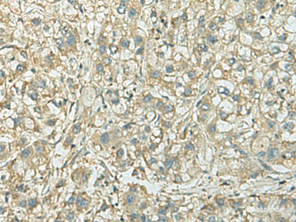 Immunohistochemistry of paraffin-embedded Human liver cancer tissue  using KIF21B Polyclonal Antibody at dilution of 1:40(×200)