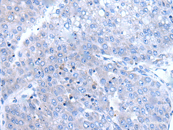 Immunohistochemistry of paraffin-embedded Human liver cancer tissue  using BTG4 Polyclonal Antibody at dilution of 1:65(×200)