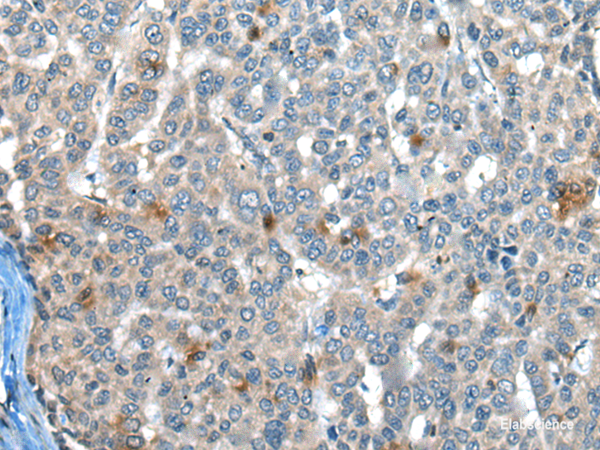 Immunohistochemistry of paraffin-embedded Human liver cancer tissue  using CAPN3 Polyclonal Antibody at dilution of 1:30(×200)