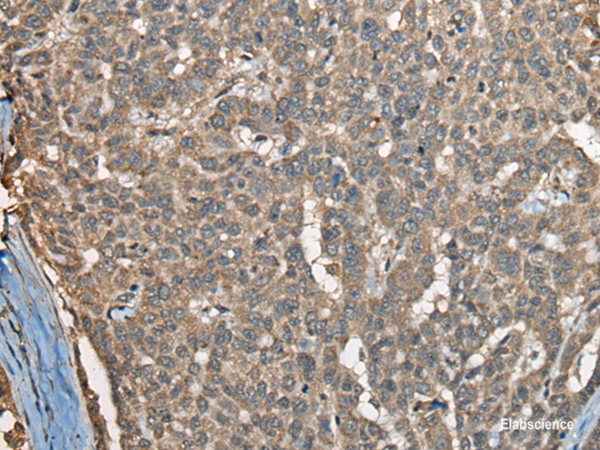 Immunohistochemistry of paraffin-embedded Human liver cancer tissue  using COX7A2L Polyclonal Antibody at dilution of 1:30(×200)