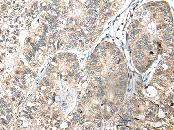 Immunohistochemistry of paraffin-embedded Human gastric cancer tissue  using SLAMF7 Polyclonal Antibody at dilution of 1:30(×200)