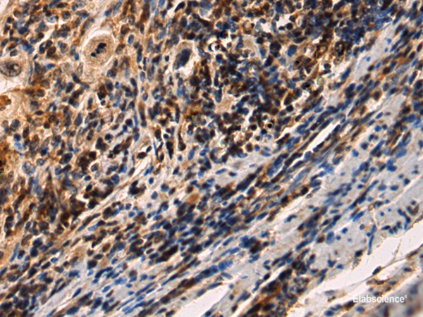 Immunohistochemistry of paraffin-embedded Human esophagus cancer tissue  using IRAK2 Polyclonal Antibody at dilution of 1:60(×200)