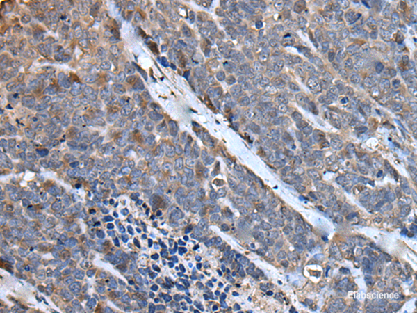 Immunohistochemistry of paraffin-embedded Human thyroid cancer tissue  using MCM10 Polyclonal Antibody at dilution of 1:50(×200)