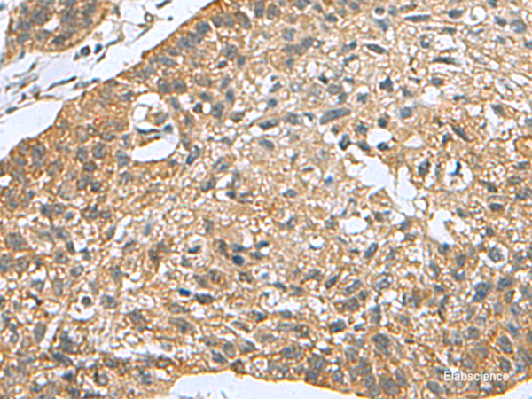Immunohistochemistry of paraffin-embedded Human esophagus cancer tissue  using PDCD5 Polyclonal Antibody at dilution of 1:105(×200)