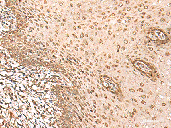 Immunohistochemistry of paraffin-embedded Human esophagus cancer tissue  using BAP1 Polyclonal Antibody at dilution of 1:35(×200)